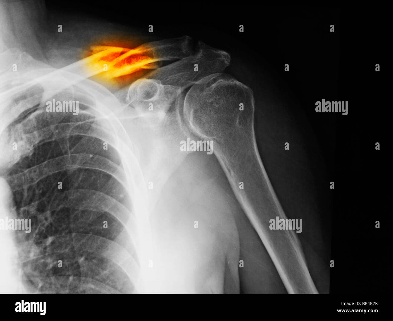 x-ray zeigt eine Fraktur der Klavikula Stockfoto