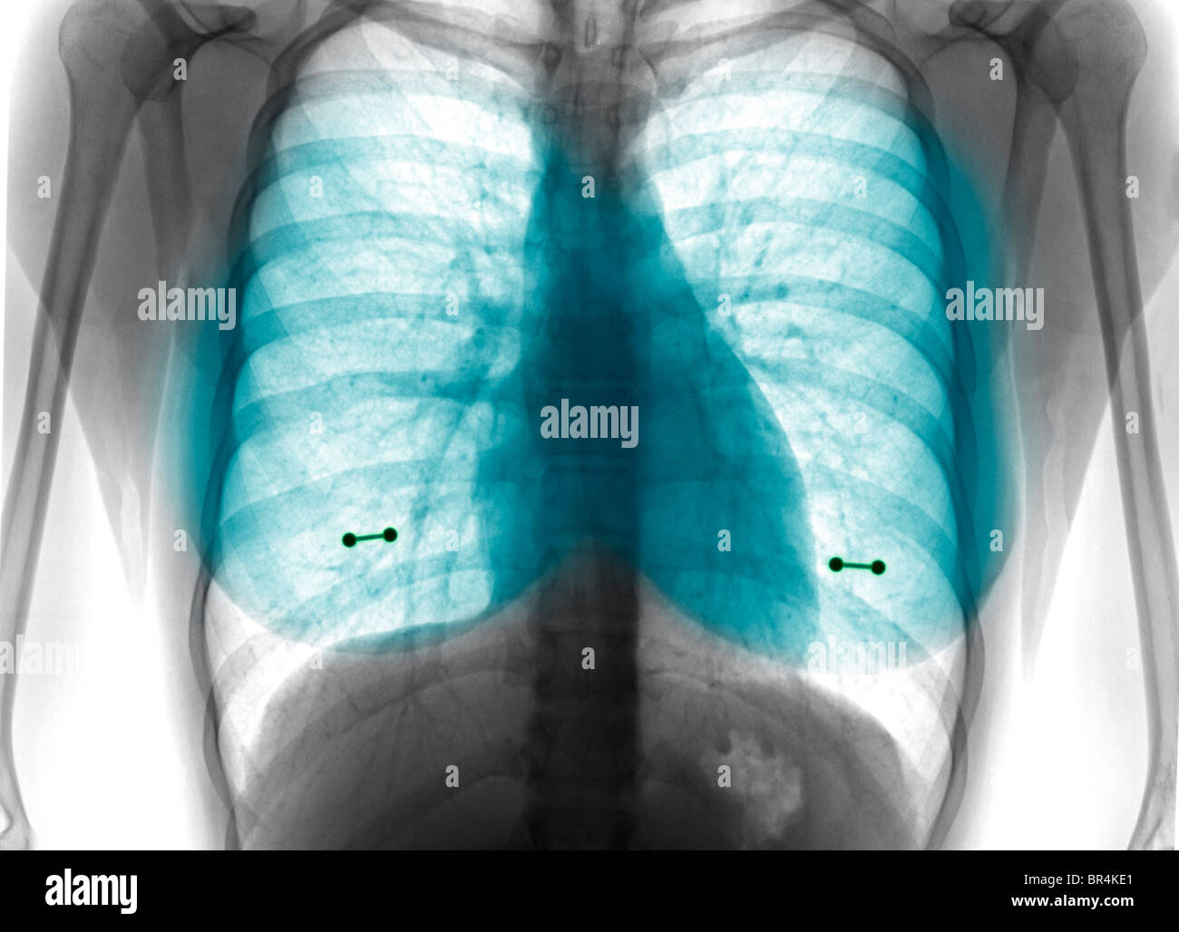 x-ray zeigt Brustwarzenpiercings bei einer jungen Frau, Brust Röntgen zeigt Brustwarzenpiercings Stockfoto