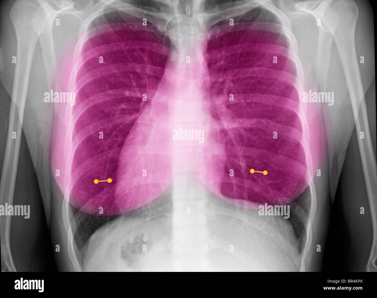 x-ray zeigt Brustwarzenpiercings bei einer jungen Frau, Brust Röntgen zeigt Brustwarzenpiercings Stockfoto