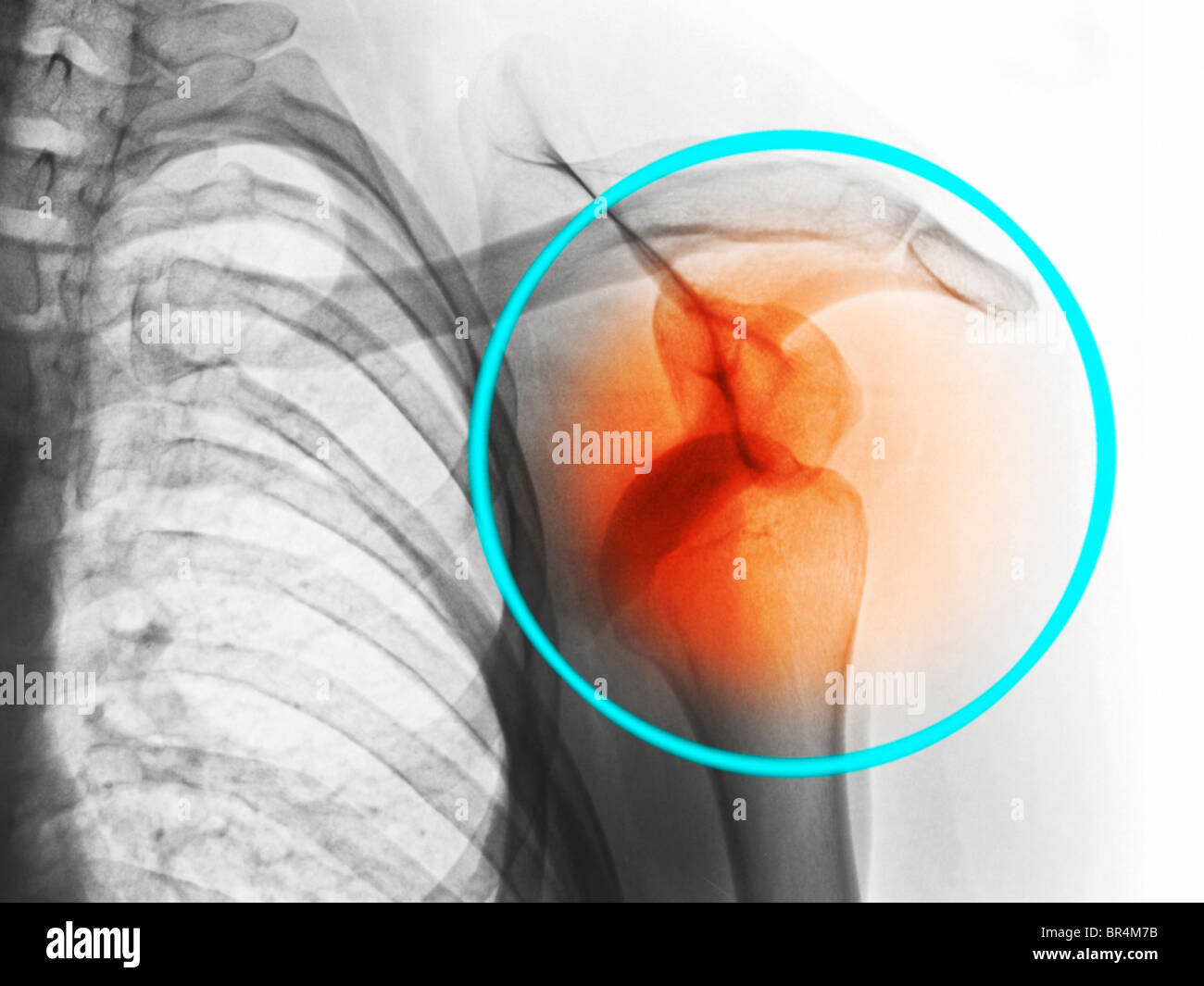 x-ray zeigt eine Schulterluxation in ein 26 Jahre alter Mann Stockfoto