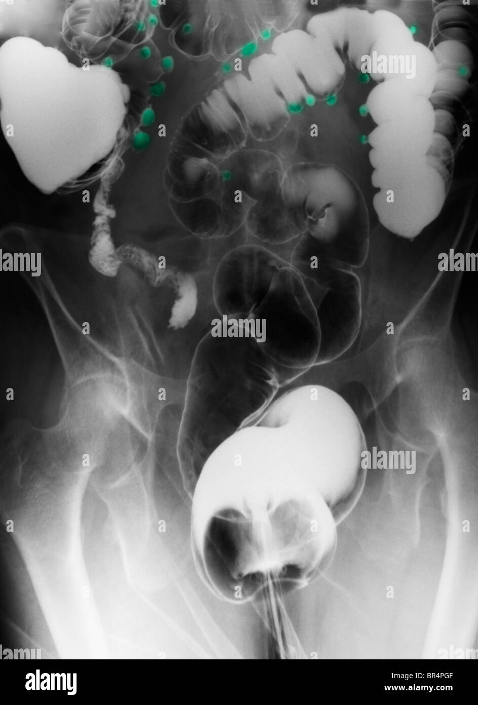 Bauch-x-ray Barium Kontrast Untersuchung zeigt Divertikulose des Dickdarms eine 67-jährige Frau Stockfoto