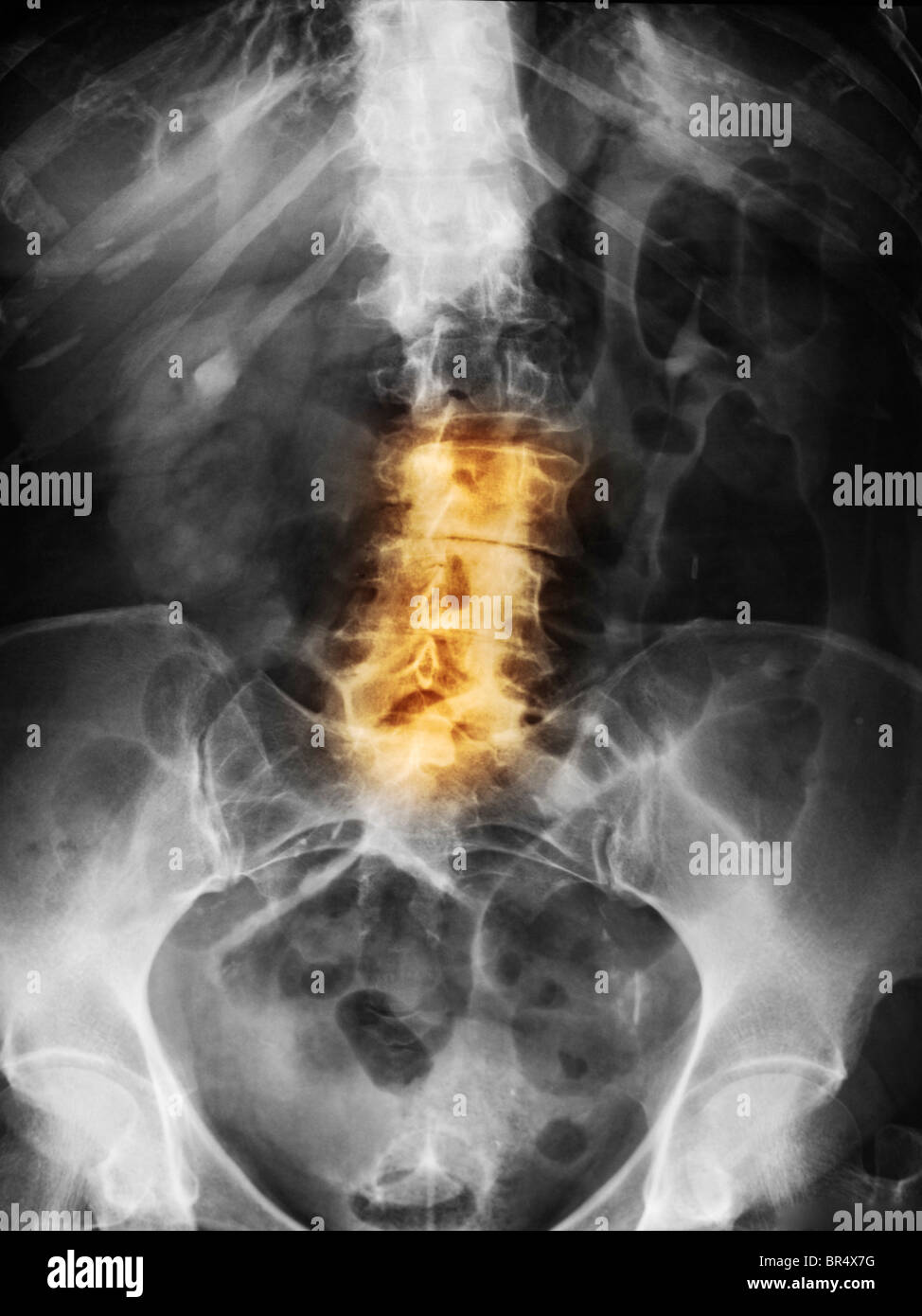 Lendenwirbelsäule Röntgenbild eine 79 Jahre alte Frau mit Arthrose (Arthrose) der unteren Wirbelsäule Stockfoto