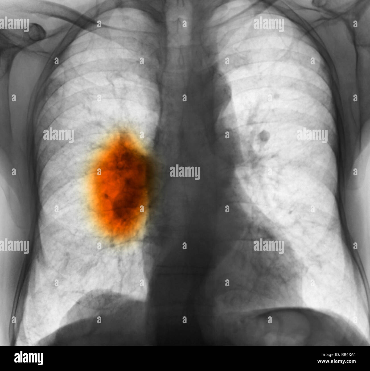 x-ray zeigt Lungenkrebs in einem 80 Jahre alten Mann mit einer langen Geschichte des Rauchens Stockfoto