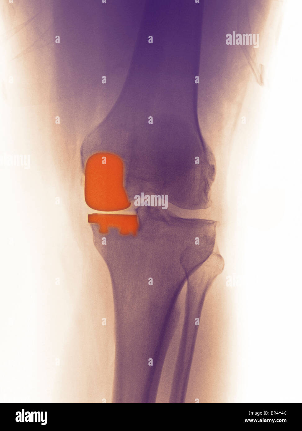 Knie Röntgen ein 49 Jahre alter Mann mit einer teilweisen Knie-Totalprothese mit der medialen Kondylus Stockfoto