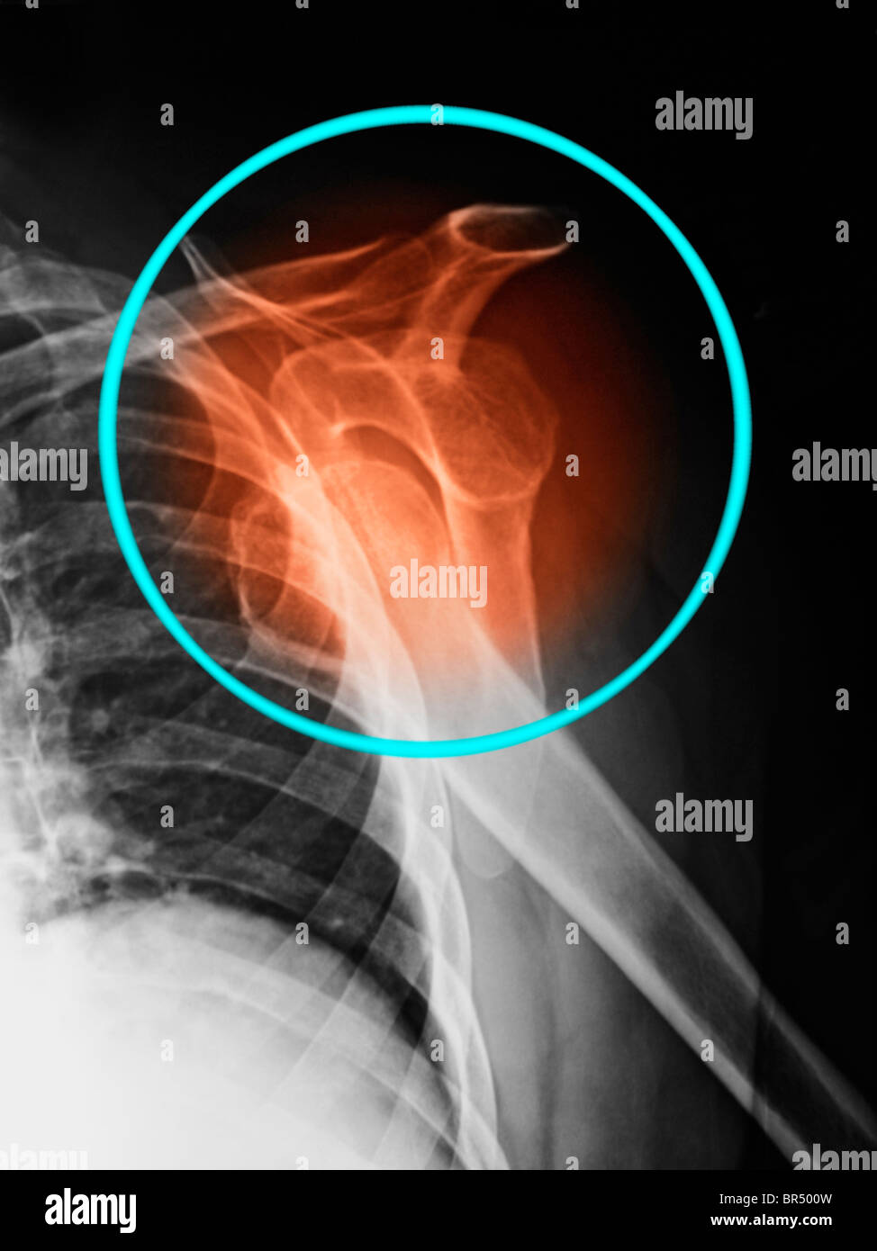 x-ray zeigt eine Schulterluxation in ein 69 Jahre alter Mann Stockfoto