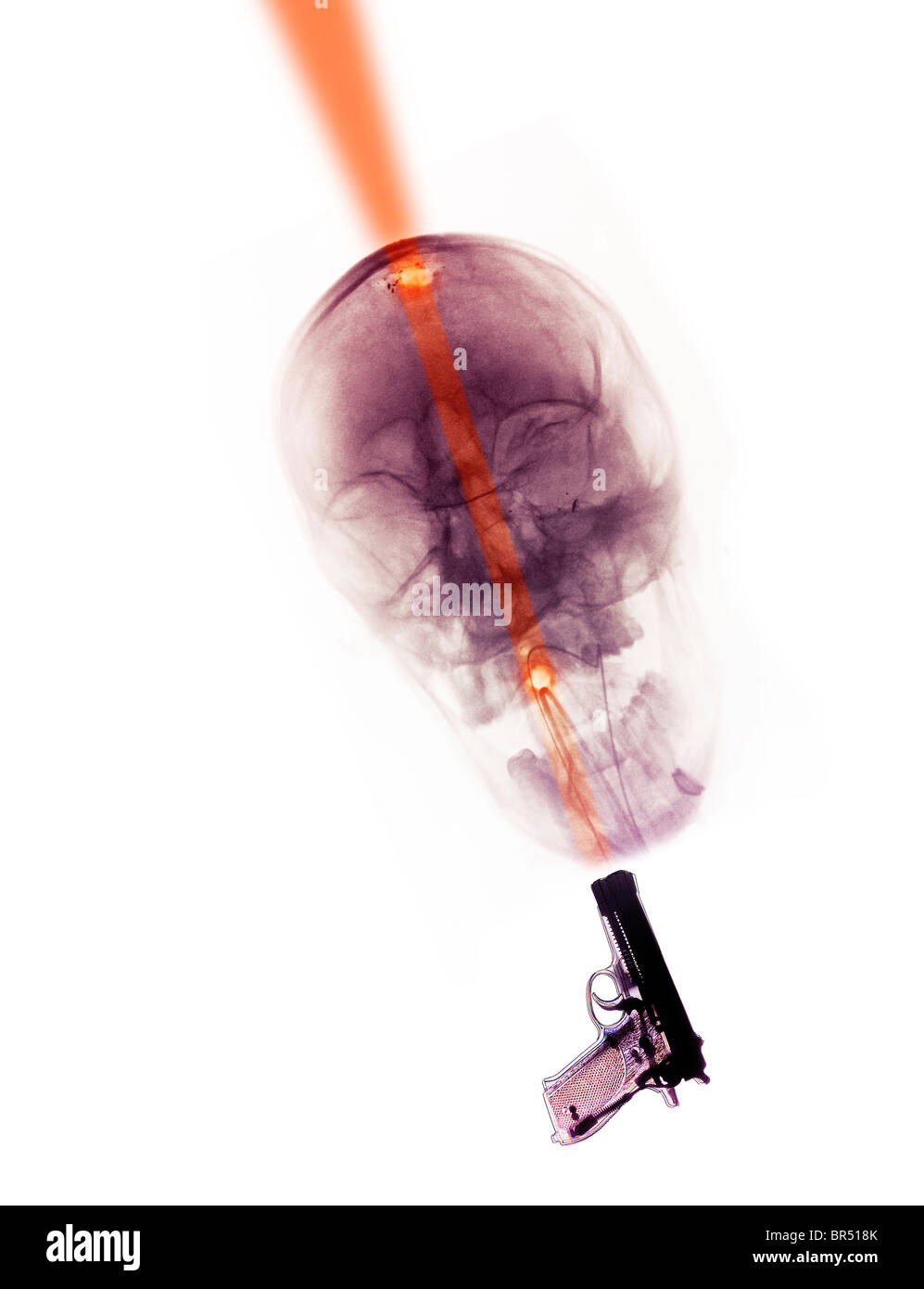 Skull x-ray ein 30 Jahre alter Mann, der Selbstmord beging, indem Sie selbst in den Kopf schießen. Stockfoto