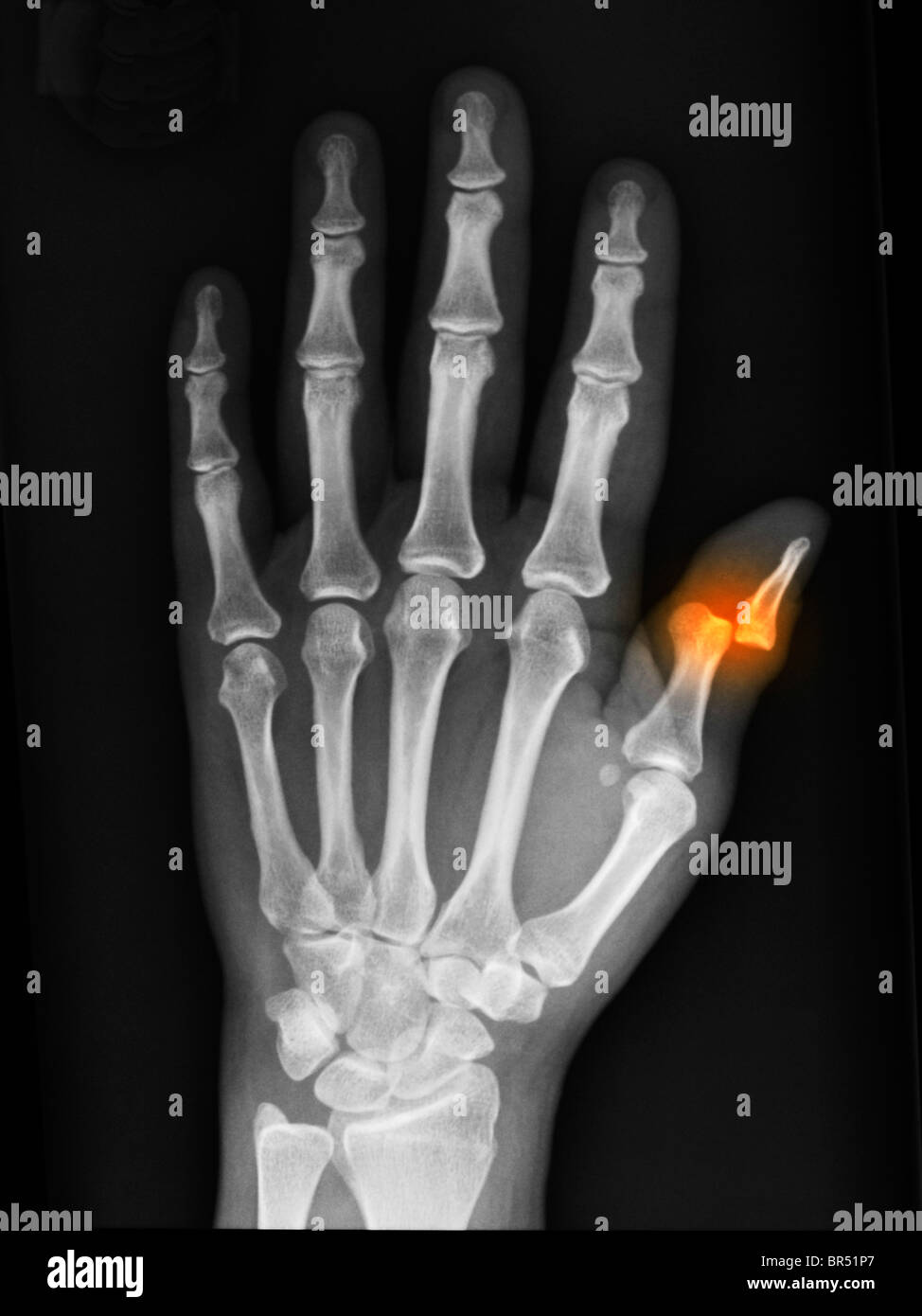 Hand Röntgen eine 36 jährige Frau, die eine Verschiebung der distalen Phalanx des Daumens Stockfoto