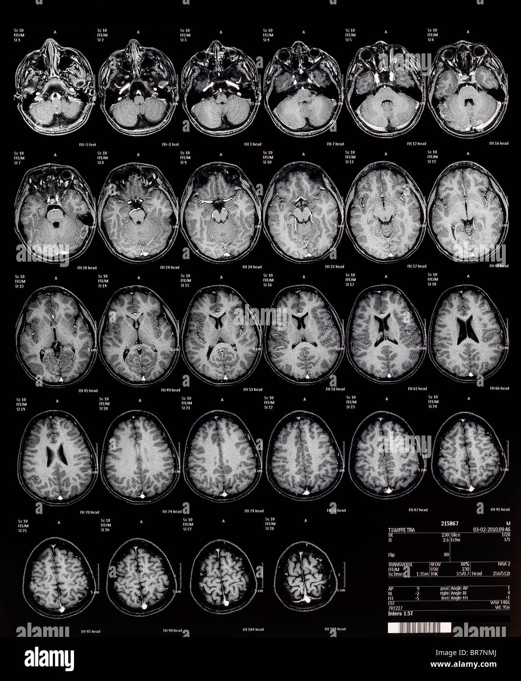 Gehirn MRT Magnetresonanztomographie oder NMRI kernmagnetische Resonanz-Bildgebung der Kinder- Stockfoto