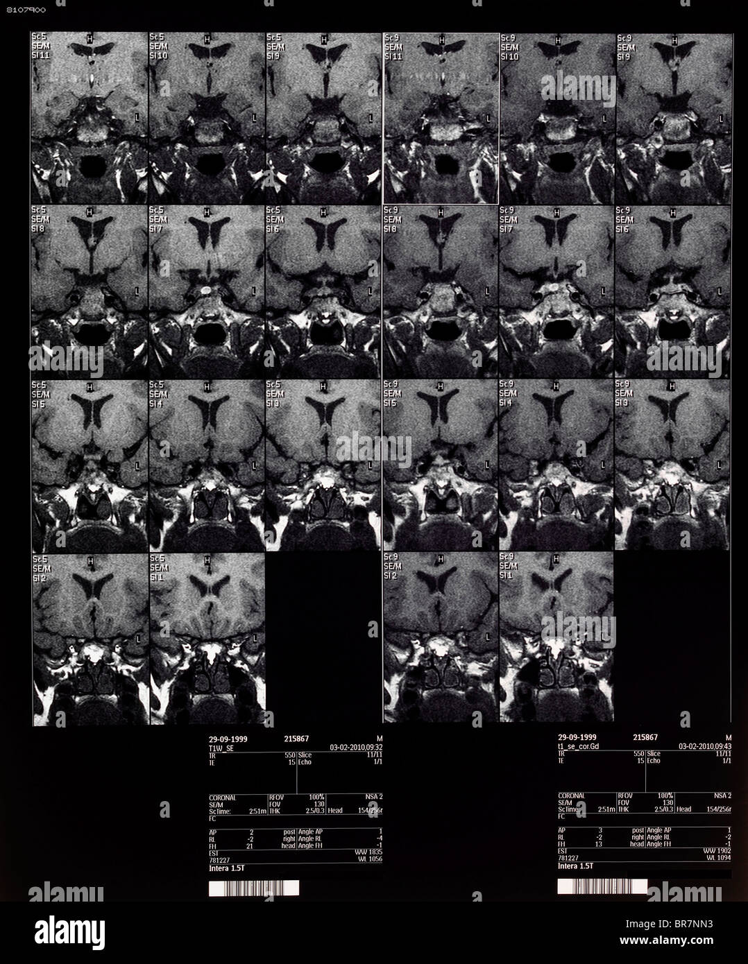 Gehirn MRT Magnetresonanztomographie oder NMRI kernmagnetische Resonanz-Bildgebung der Kinder- Stockfoto