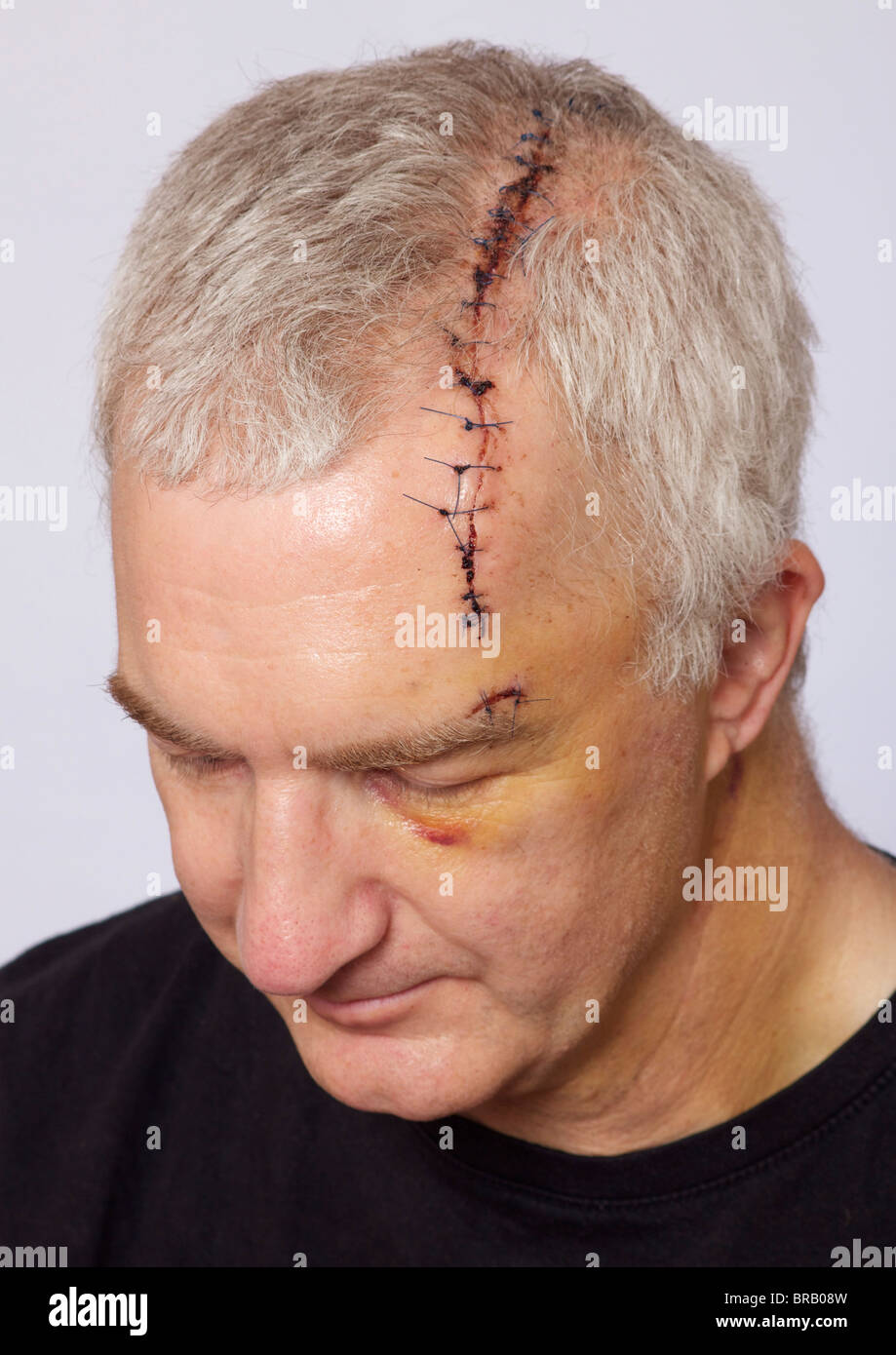 Mann mit langen Kopf Wunde und Stiche Stockfoto