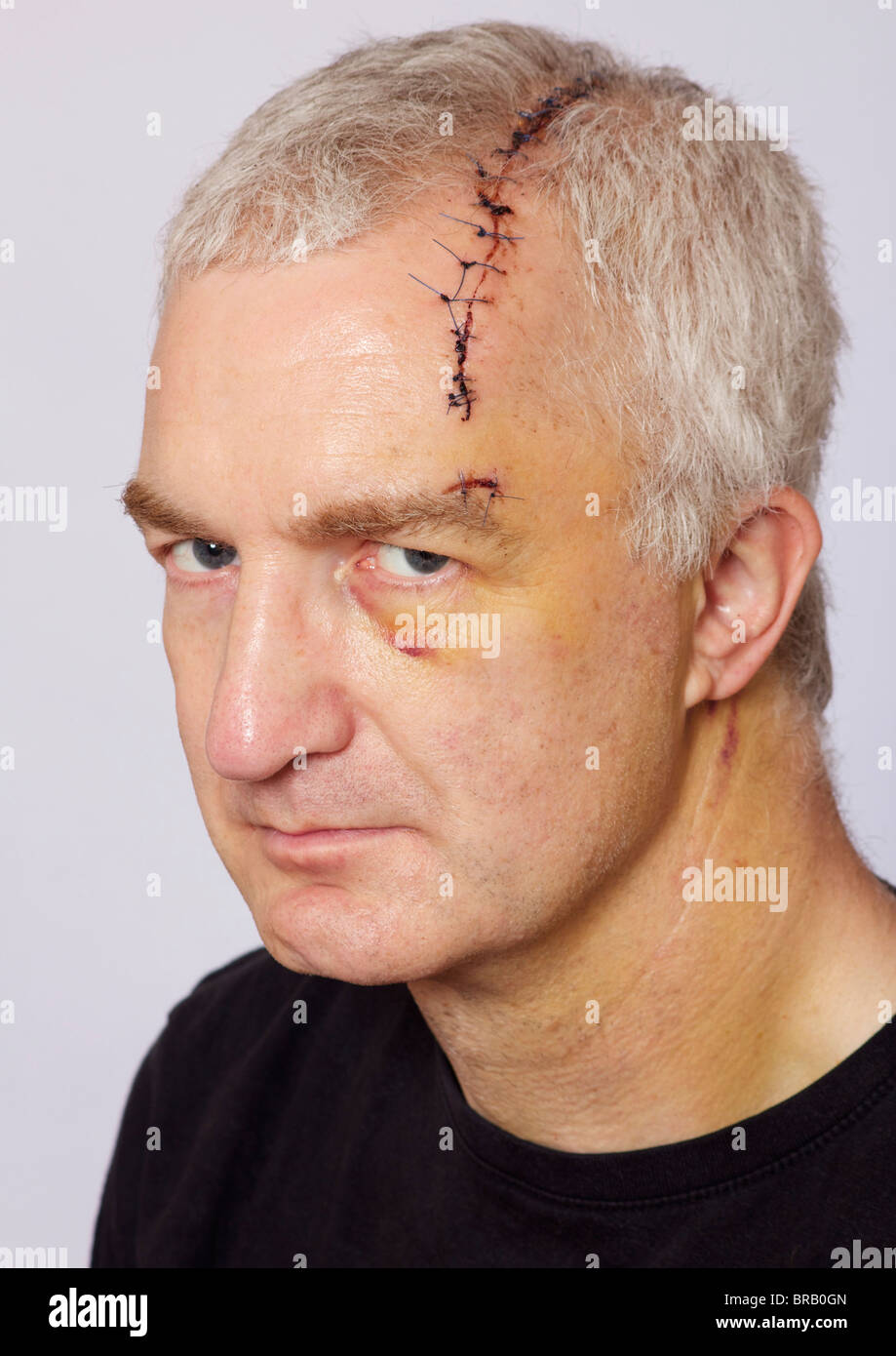Mann mit langen Kopf Wunde und Stiche Stockfoto