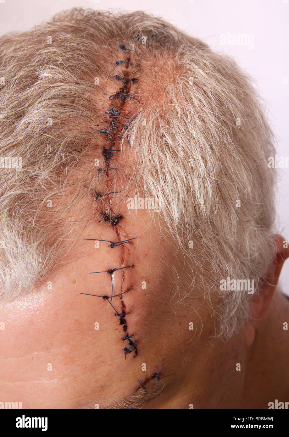 Mann mit langen Kopf Wunde und Stiche Stockfoto