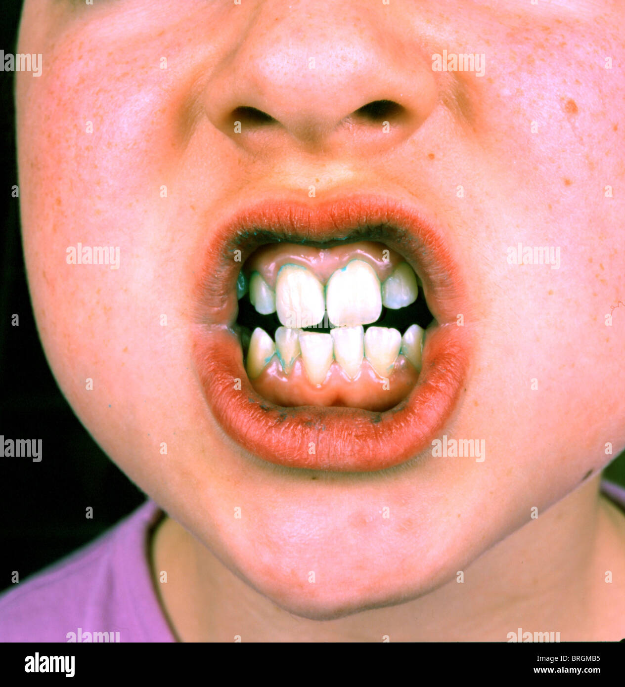Zähne nach der Verwendung von Plaque Offenlegung tablet Stockfoto