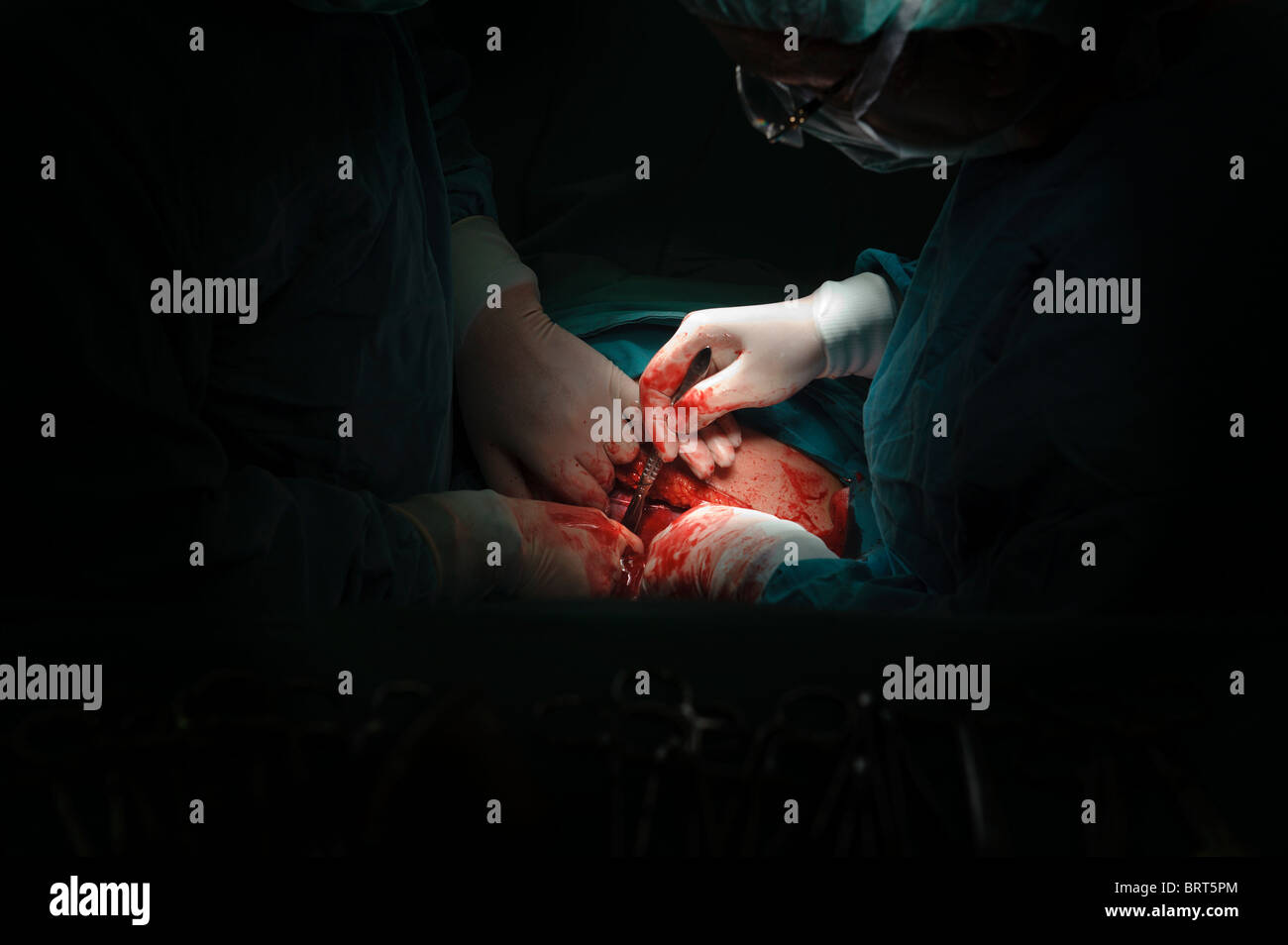 Kaiserschnitt Stockfoto