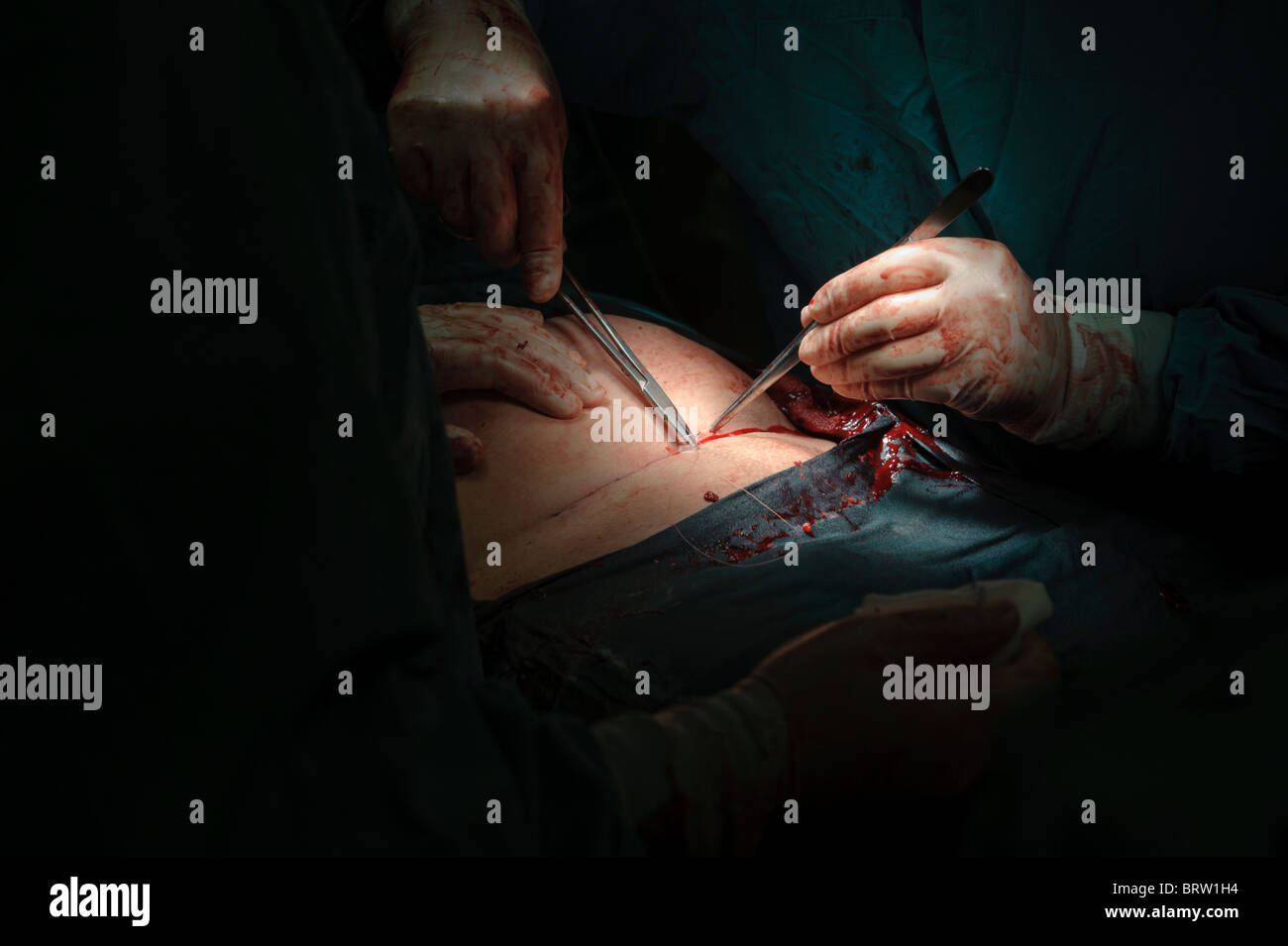 Kaiserschnitt Stockfoto