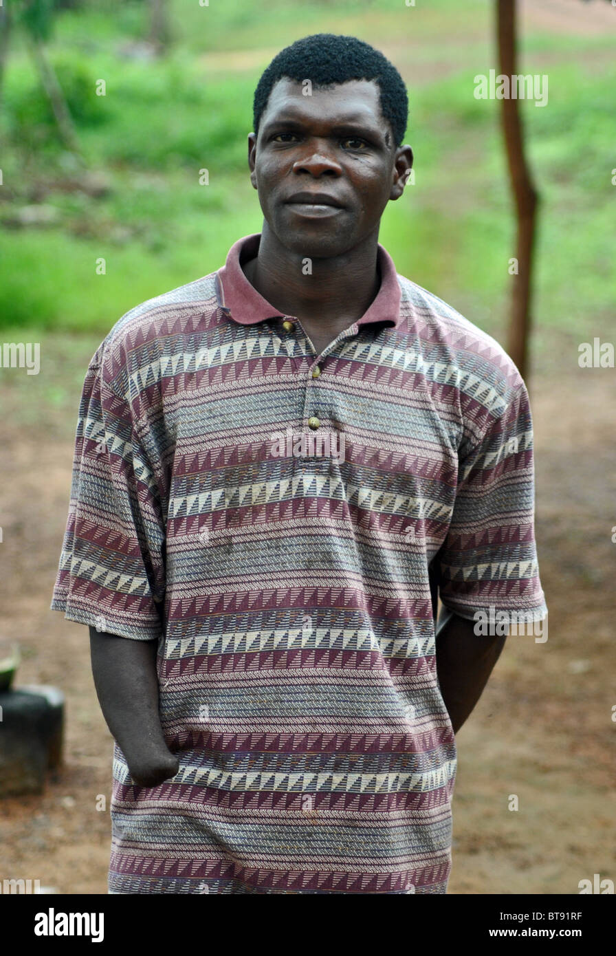 Liberianische Amputierte Flüchtling, Tabou, Elfenbeinküste, Westafrika. Verlor seine Hand ivorischen Bürgerwehr in 2003 Stockfoto