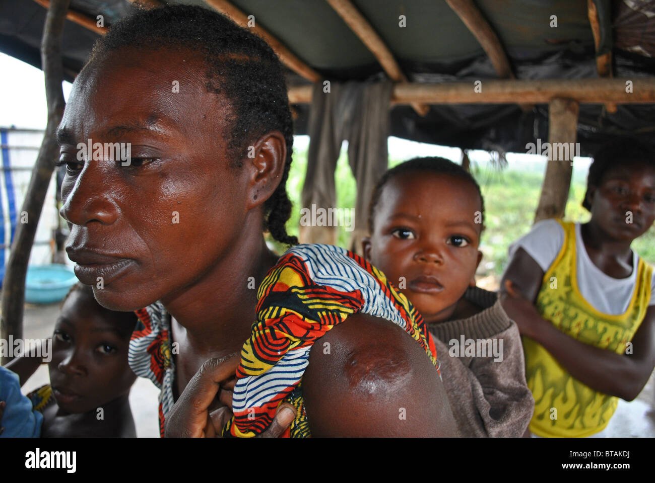 Liberianische Flüchtlings Frau mit Schusswunde in ihrer Schulter, Tabou Transit Camp, Elfenbeinküste, Westafrika Stockfoto