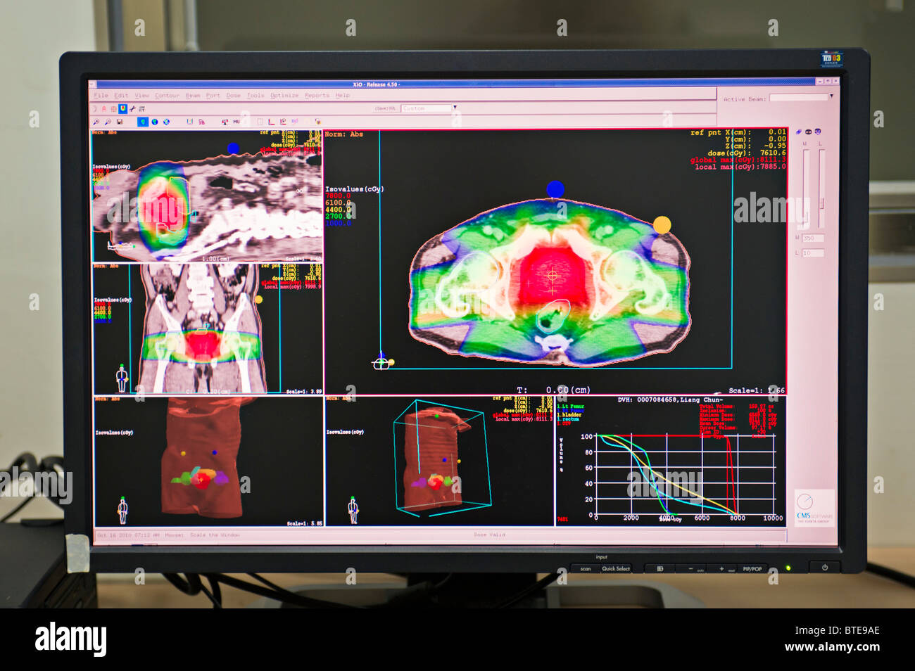 Computer-Monitor im Krankenhaus Onkologie-Abteilung, die CT-Bilder Stockfoto