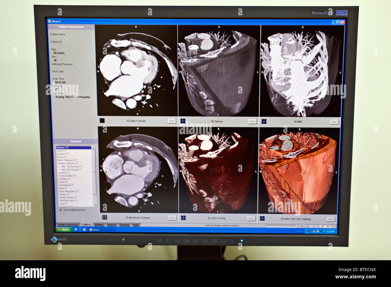 PET-CT Scann, CAT-Scan, auf Computer-Monitor, Nahaufnahme Stockfoto
