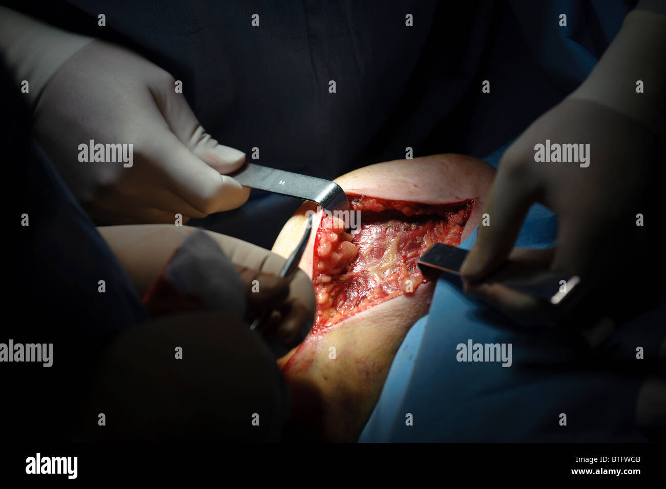 Ärzte der Chirurgie im OP-Saal Stockfoto