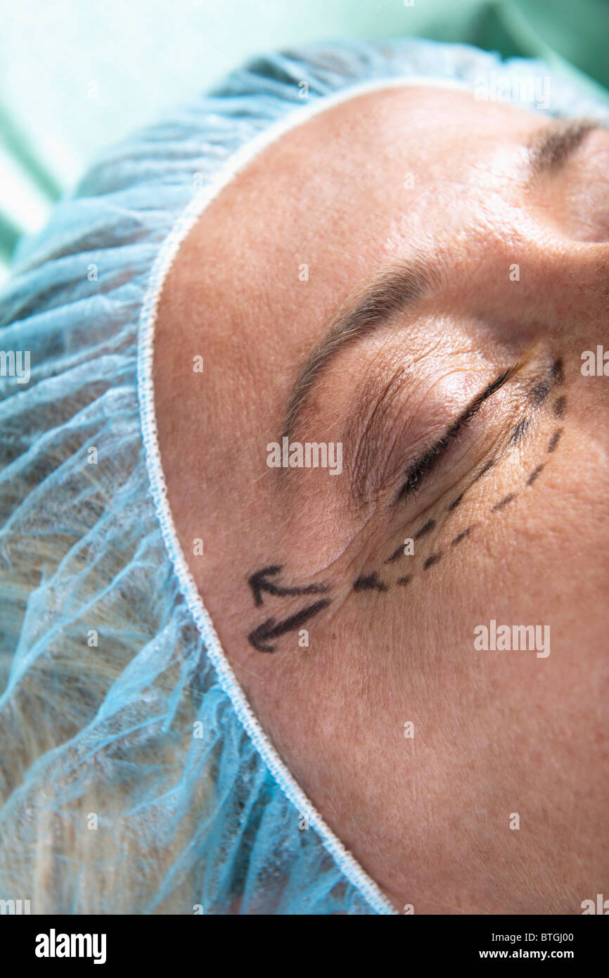 Nahaufnahme von Gesicht des Patienten mit Schnitt-Linien Stockfoto