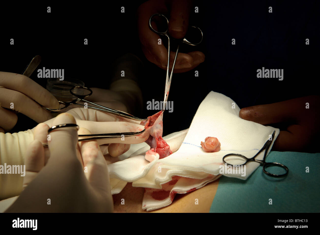 Hodentumor chirurgische Entfernung, Urologie Stockfoto