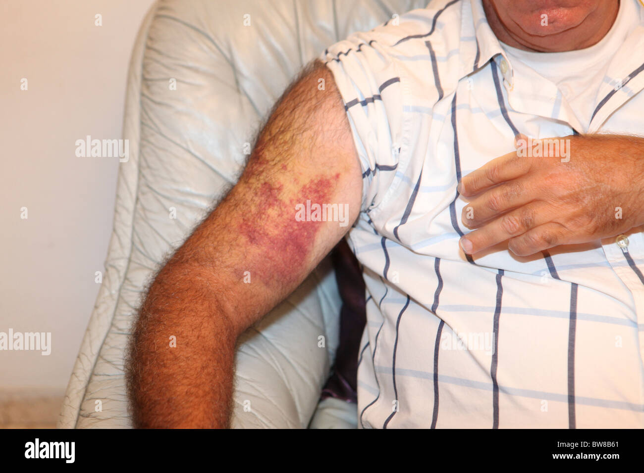 Erysipel an einem Arm. Nahaufnahme der geschwollenen & entzündete Haut eines jungen Mannes. Stockfoto