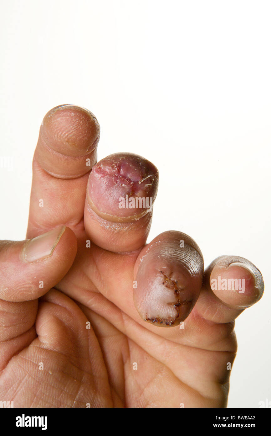 Männchen der linken Hand auf weißem Hintergrund fehlen zwei Finger hautnah Stockfoto