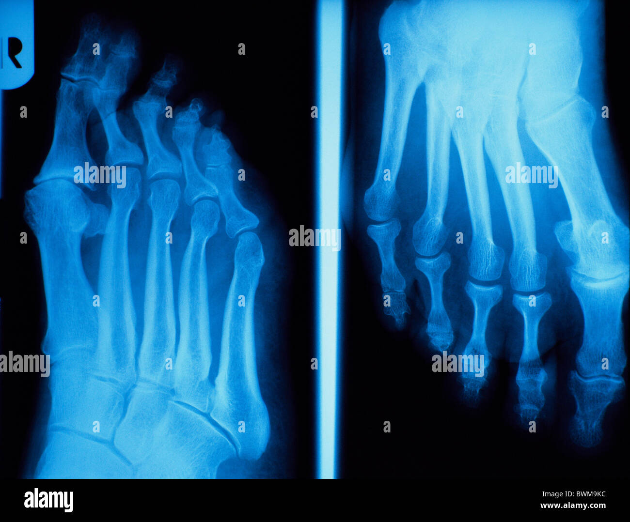 X-ray Xray Röntgenbild Röntgen Krankenhaus Medizin richtig Fuß Bone ...