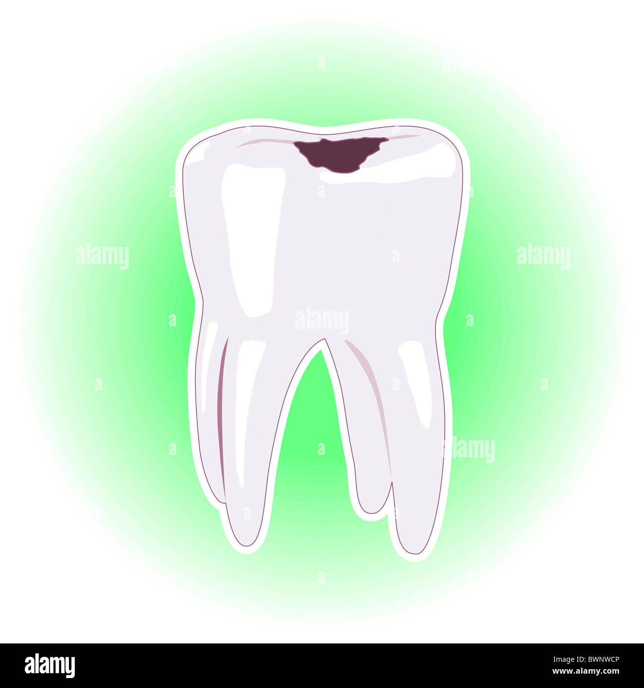 Zahn mit Hohlraum oder Zahnfüllung Illustration isoliert auf weißem Hintergrund grün Stockfoto