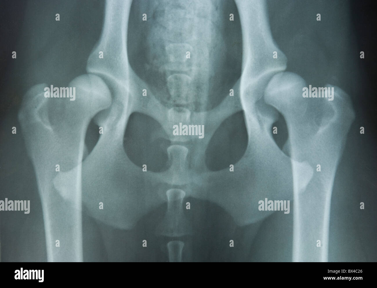 Röntgen der Hüftdysplasie Stockfoto