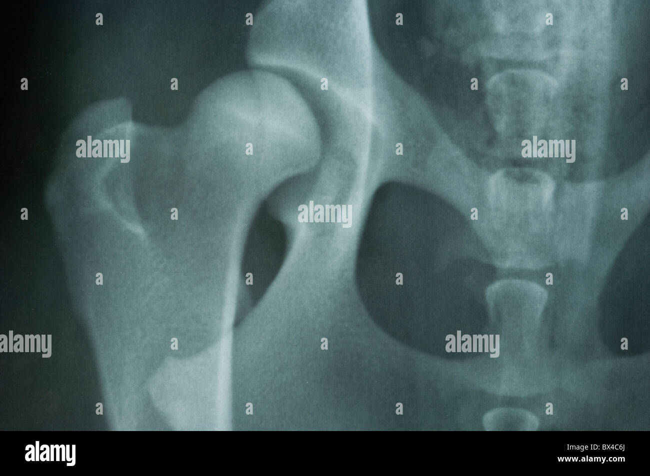 Röntgen der Hüftdysplasie Stockfoto