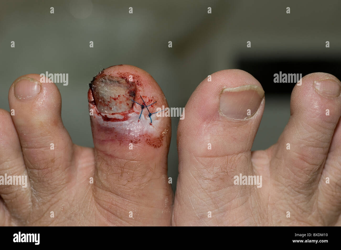 verletzten Zehe Stockfoto