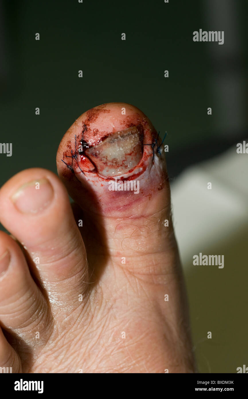 verletzten Zehe Stockfoto