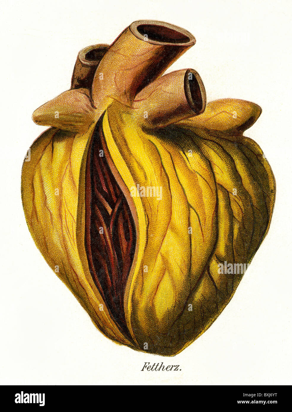 Medizin, Krankheiten, Herzkrankheiten, Fettherz, Lithographie, Deutschland, um 1900, Zusatz-Rechte-Clearenzen-nicht vorhanden Stockfoto
