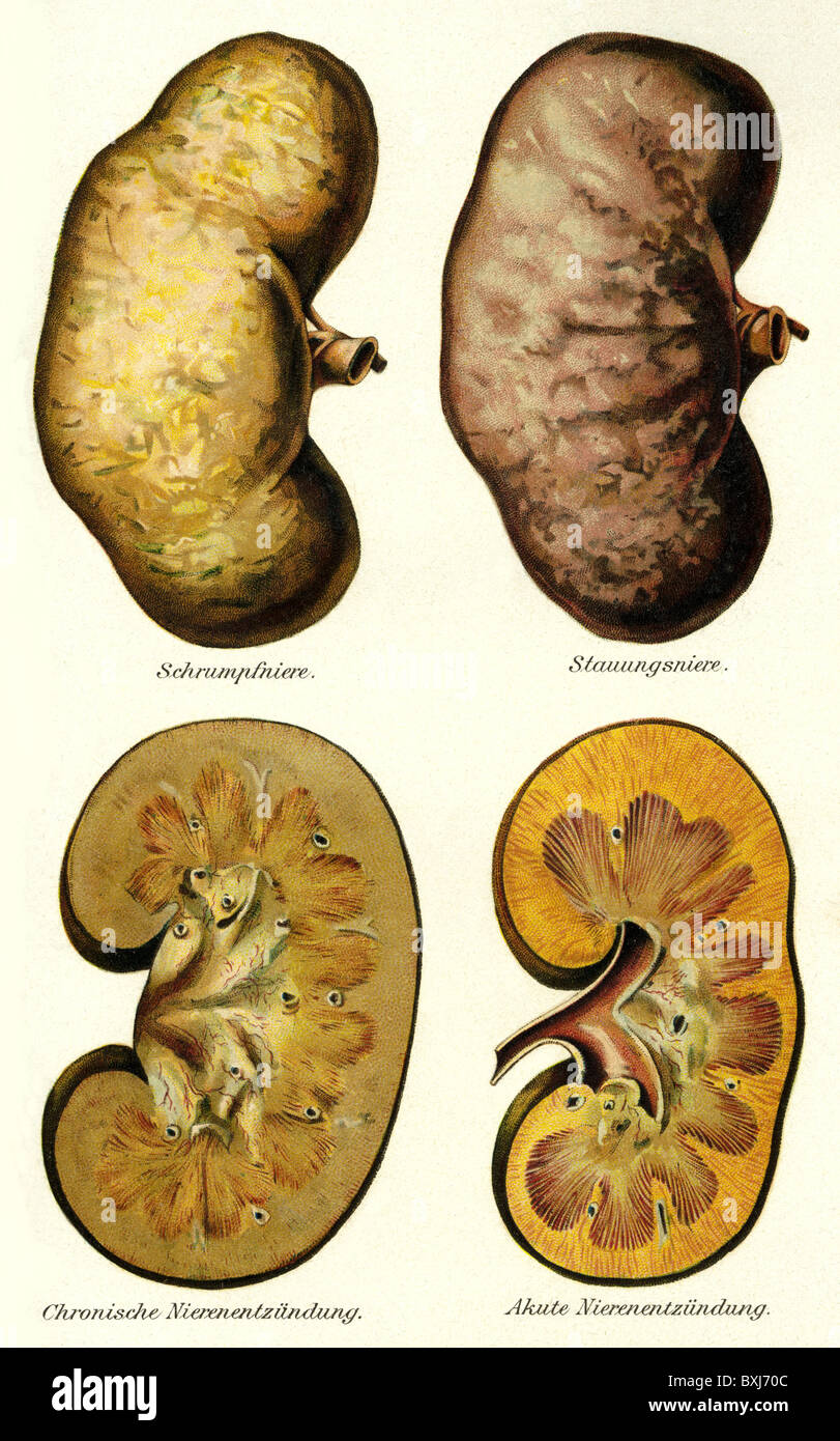 Medizin, Krankheiten, Nierenerkrankungen, Lithographie, Deutschland, um 1900, Zusatz-Rechte-Clearenzen-nicht vorhanden Stockfoto