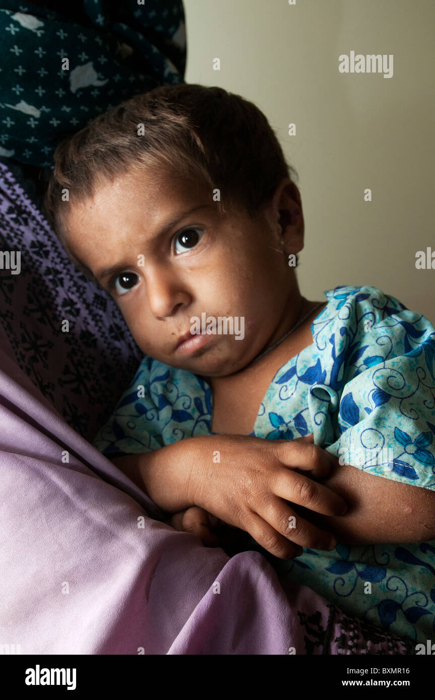 Pakistan nach der Flut. Ärzte weltweit Klinik. Naseema Beroyis Tochter, 2 Jahre alte Asifa hat Krätze. Stockfoto
