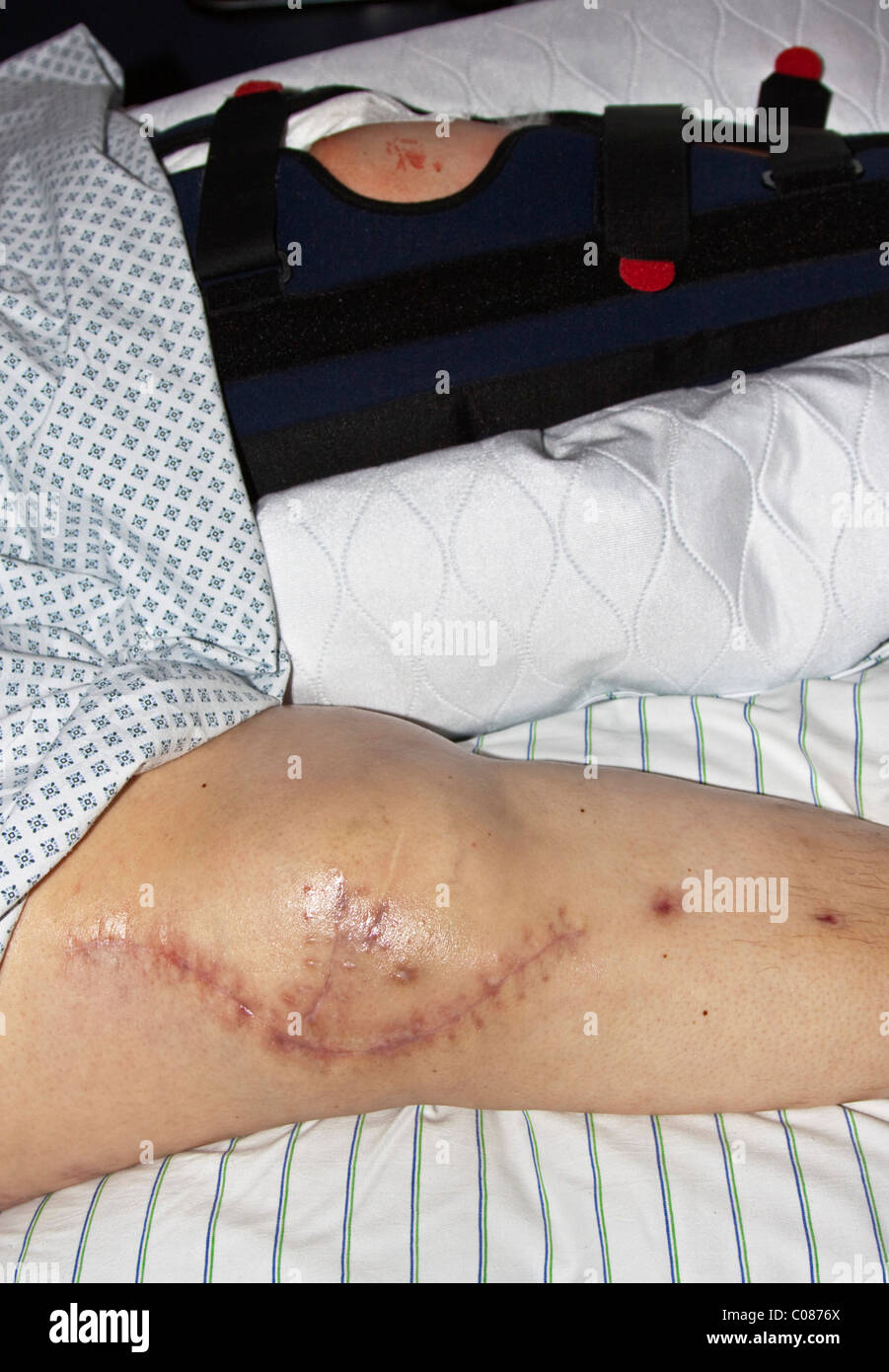 Frische Narbe auf das operierte Knie einer Frau nach dem Einsetzen von Implantaten nach einem schweren Verkehrsunfall Stockfoto