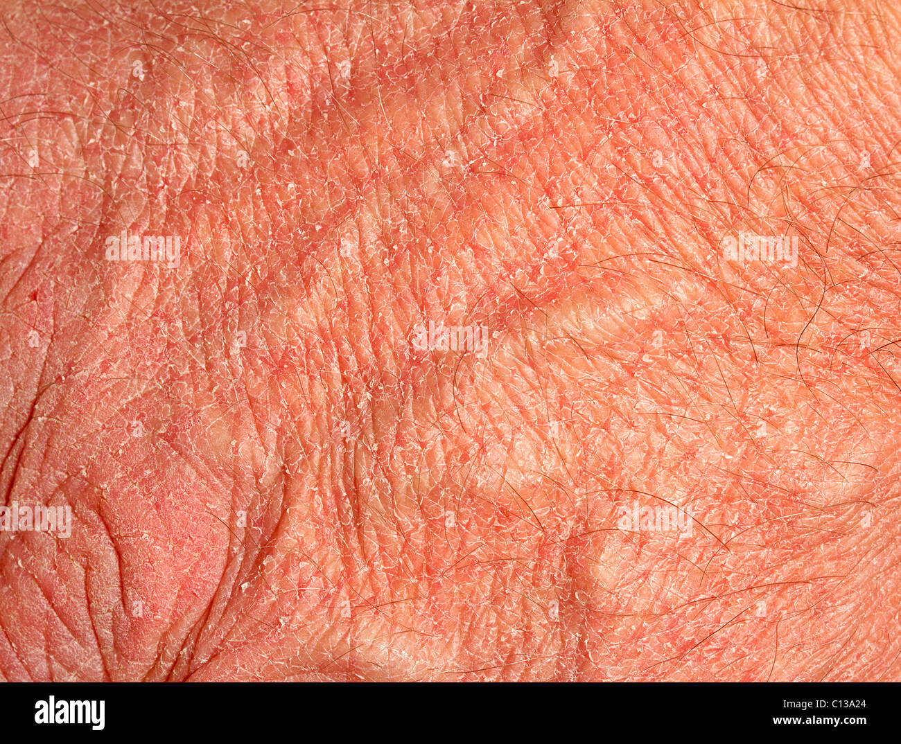 Trockene Haut auf Seite Stockfoto