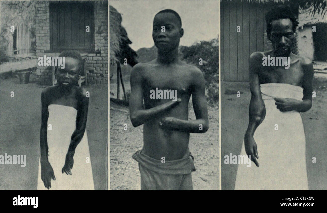 Gräueltaten der Kautschuk-Sklaverei in Belgisch-Kongo. Mongala (links) und Biasia (rechts) Arme zerplatzten durch Schüsse der "Kautschuk-Wachposten", die ihr Dorf angegriffen, wenn es nicht zu seinen Kautschuk-Steuer-Quote zu erfüllen. Mola Enuliti (Mitte) Hände waren durch Wachen Gewehrkolben zertrümmert. Stockfoto