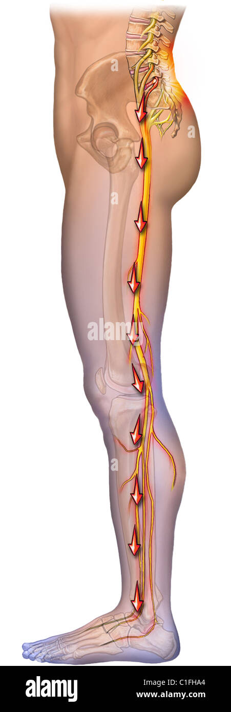 Diese medizinische Illustration bietet einen seitlichen Blick auf das Bein. Die Nerven des Beines sind im Preis inbegriffen und rote Fackel zeigt Schmerzen. Stockfoto