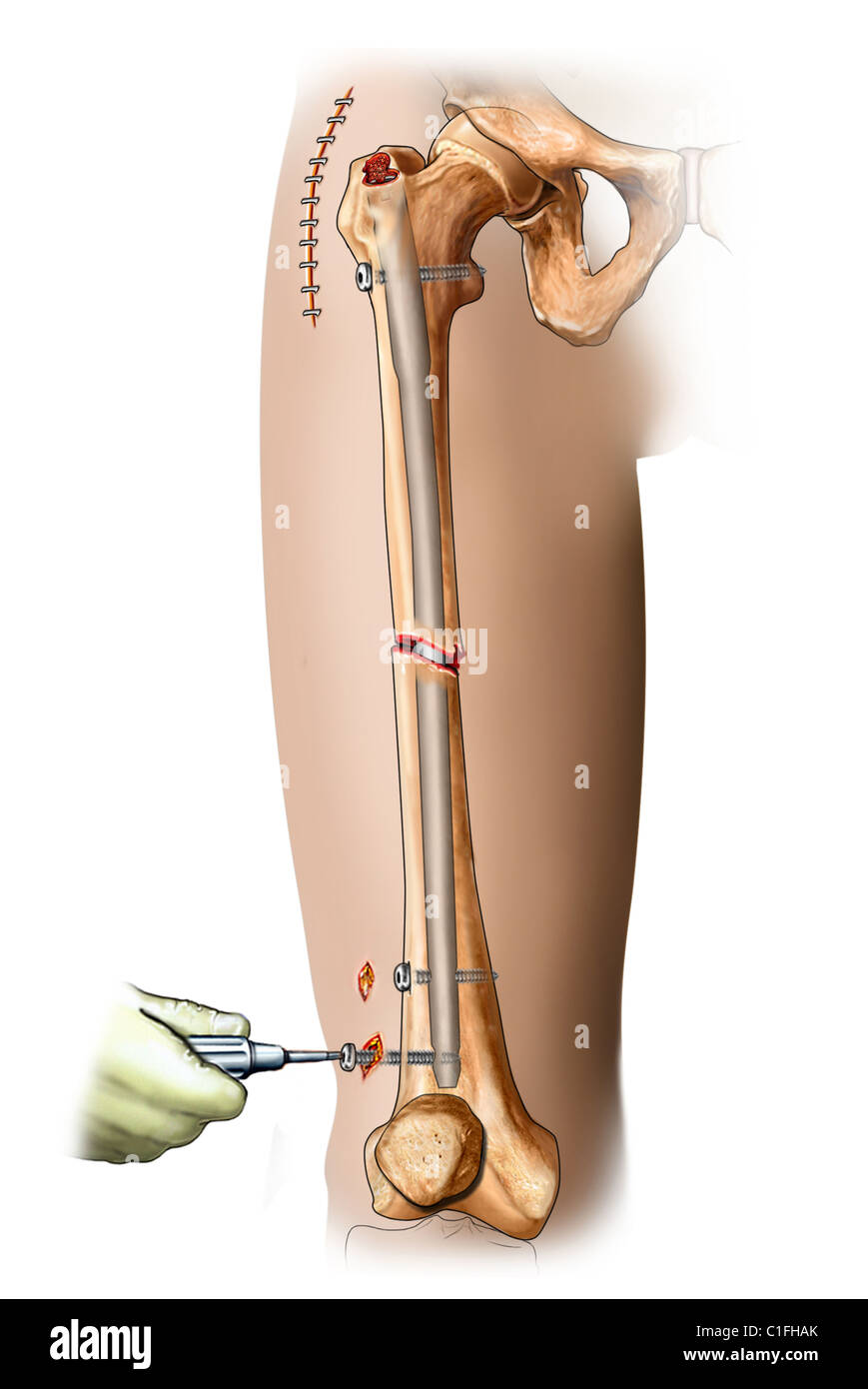 Interne Fixation des Femur Fraktur mit Intramedullay Rute innerhalb der