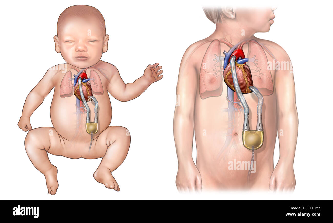 Dieses Bild bietet vergleichende anteriore Ansichten von zwei Figuren, einem Kleinkind, einem Kleinkind mit ventrikulären Links unterstützen Gerät Stockfoto