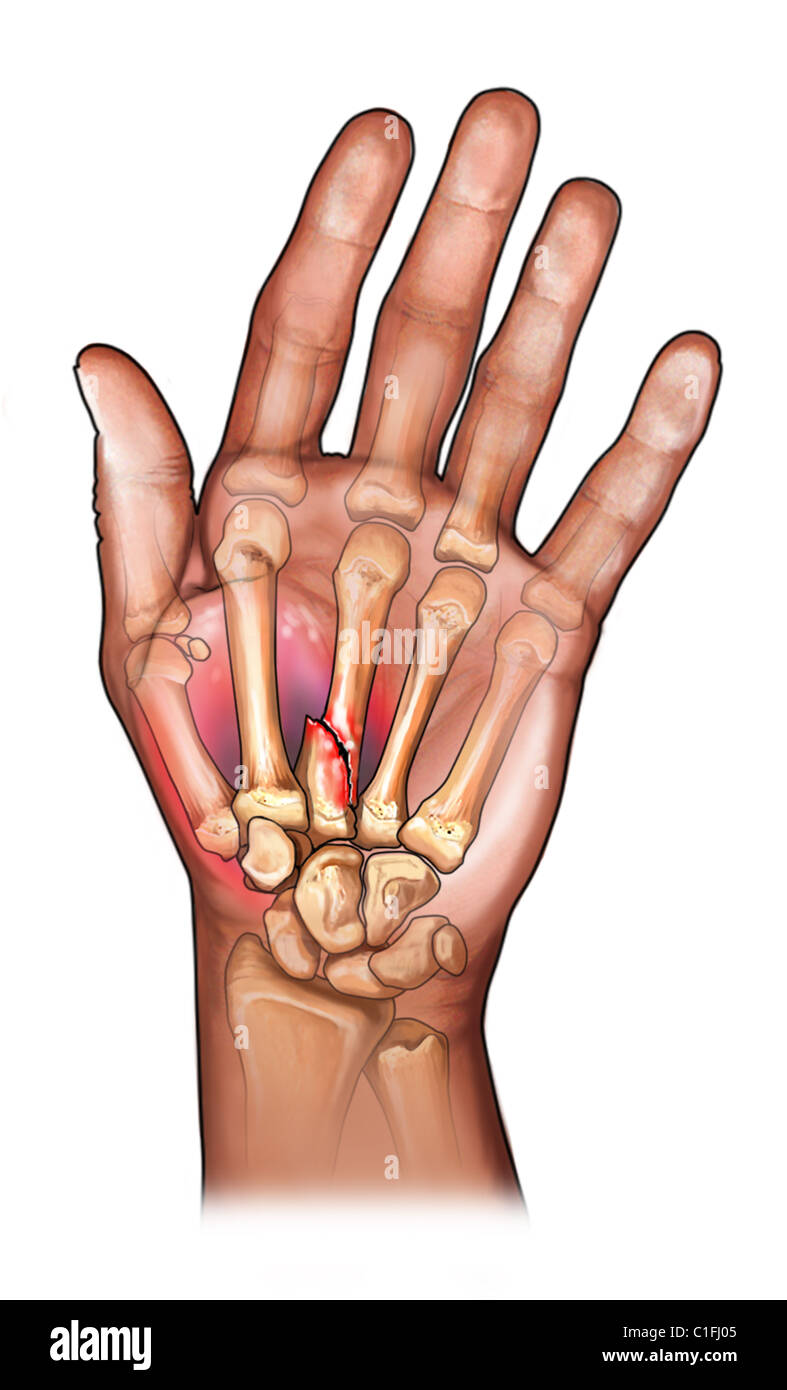 Diese medizinische Illustration zeigt einen Bruch, der dritte Mittelhandknochen Fraktur. Stockfoto