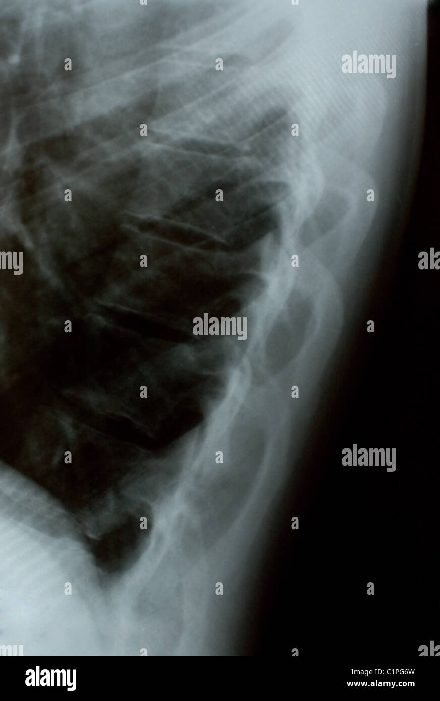 Das Xray-Foto von menschlichen Knochen Stockfoto