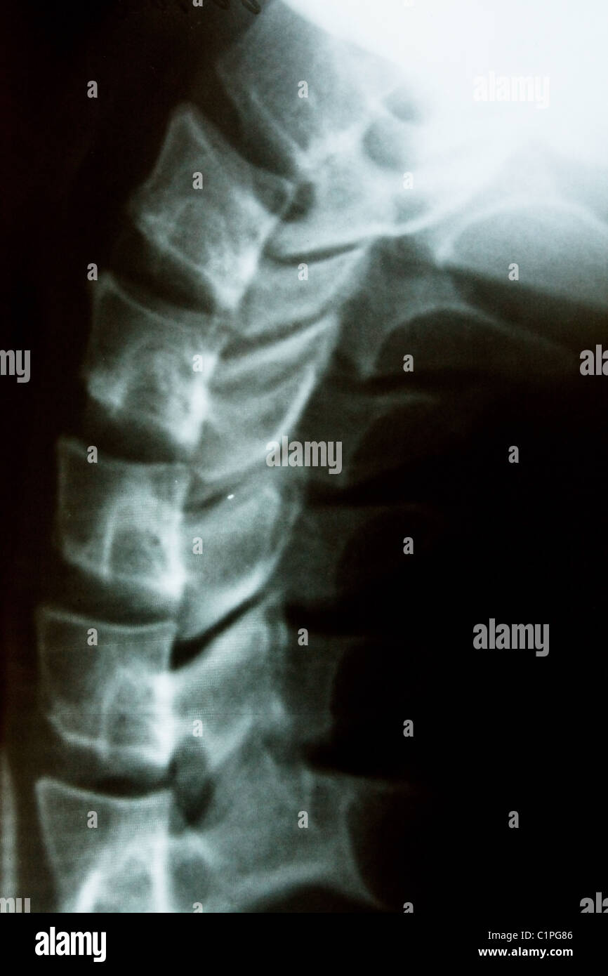 Das Xray-Foto eines menschlichen Halses Stockfoto