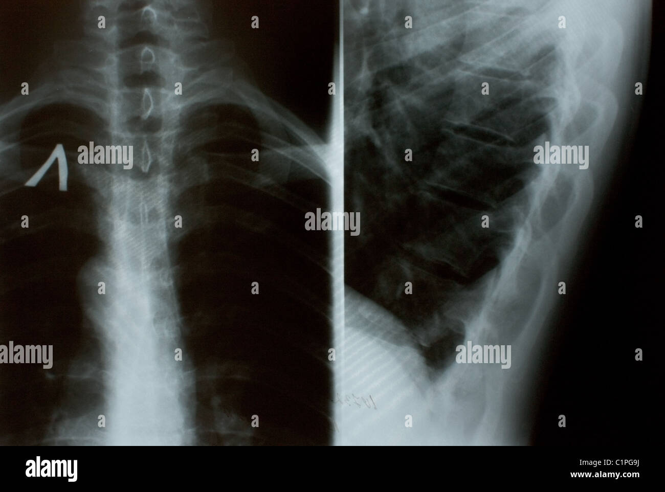 Das Xray-Foto von menschlichen Knochen Stockfoto