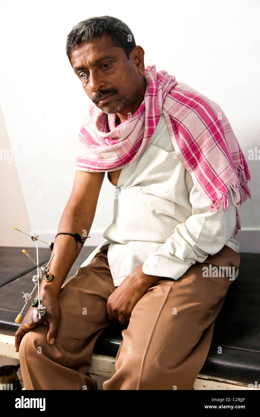 Amputierte Patienten mit einem Fixateur externe am Basveshwar Krankenhaus Sholapur Indien Stockfoto