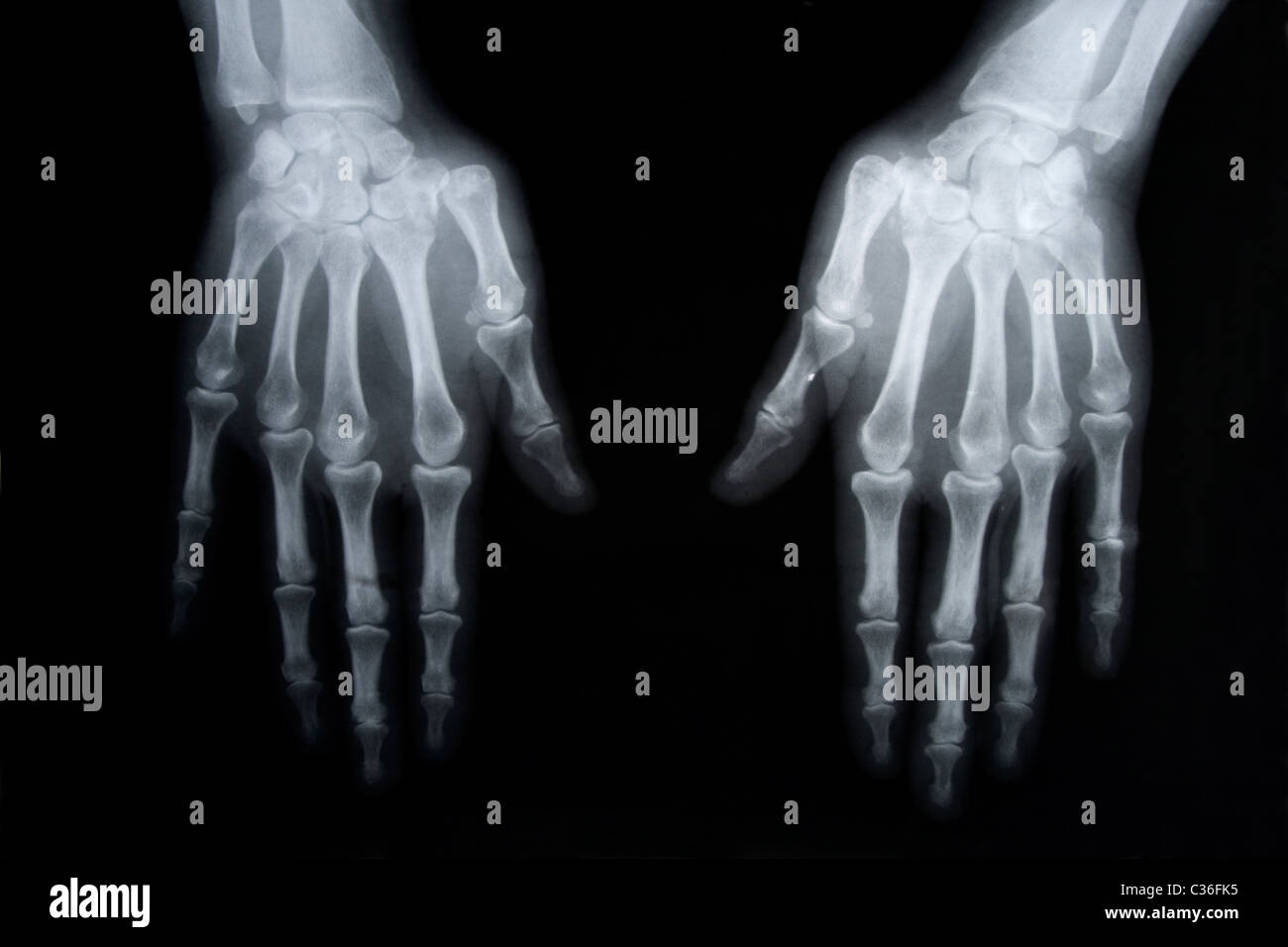 Schwarz-weiß Foto von x-ray Bild von menschlichen Händen Stockfoto