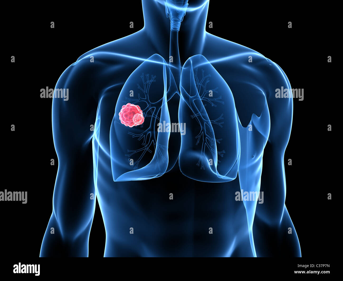 Lungenkrebs Stockfoto